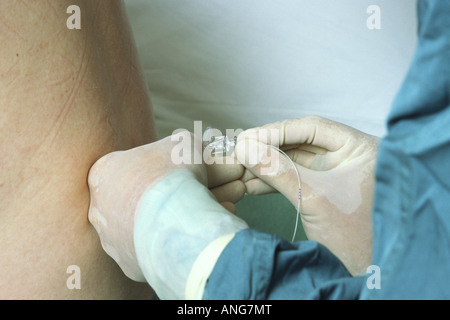 Epidural being given to a woman for pain relief during childbirth Stock Photo