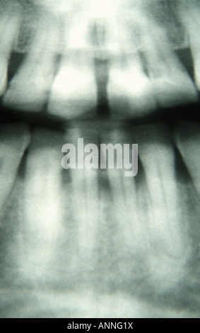 Dental X-ray image showing dental amalgam Stock Photo - Alamy