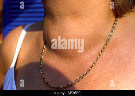 Woman with thyroid goitre Stock Photo