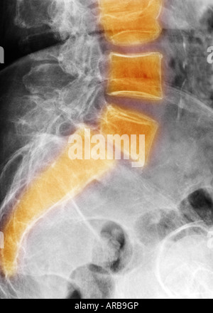 Lumbar spine xray showing a grade II anterolisthesis of L5 on S1 Stock ...