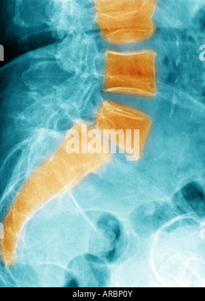 Lumbar spine xray showing a grade II anterolisthesis of L5 on S1 Stock Photo