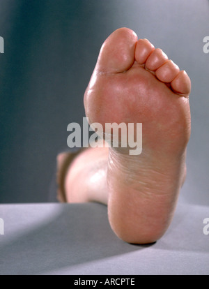 The swollen foot of a patient with gout, also known as uric acid ...