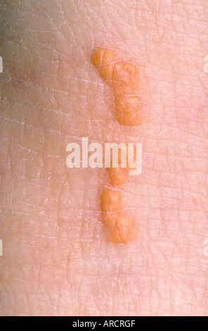 A photograph of xanthomas, symptomless yellow firm nodules usually found over bony elbows, knees and heels. Stock Photo
