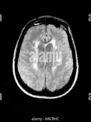 An MRI scan showing the typical demyelination due to multiple sclerosis (MS). Stock Photo