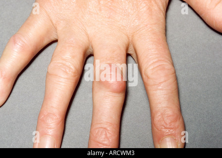 Xanthoma is a condition where fat is deposited under the surface of the skin. Stock Photo