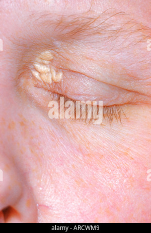 Xanthomatosis is a condition in which fatty deposits occur in various parts of the body. Stock Photo