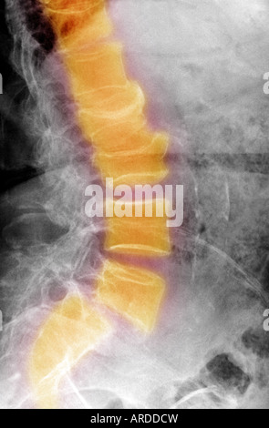 Lumbar Spine Xray Showing A Grade II Anterolisthesis Of L5 On S1 Stock ...