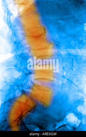 Lumbar spine xray showing a grade II anterolisthesis of L5 on S1 Stock Photo