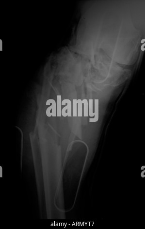 frontal view of gross knee fracture Stock Photo