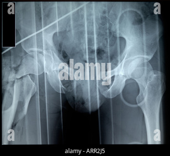 gross open book fracture of male pelvis and comminuted hip Stock Photo