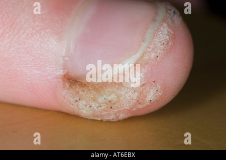 Warts On Thumb Of Child Stock Photo