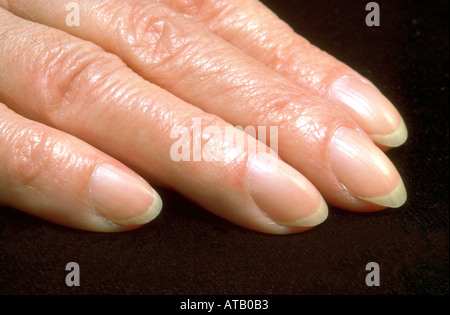 Clubbed Fingers | Clubbed fingers, Contouring and highlighting, Health