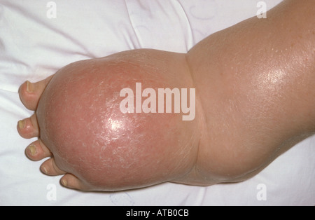 Oedema of foot Stock Photo