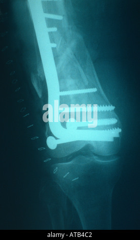X ray supracondylar fracture of femur with blade plate Stock Photo