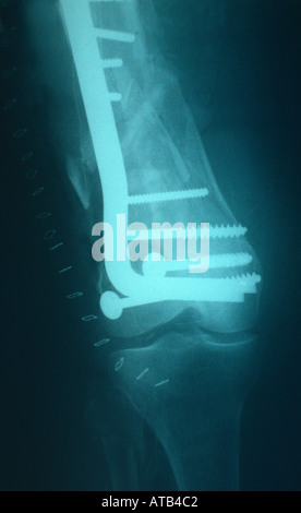 supracondylar fracture of femur x ray