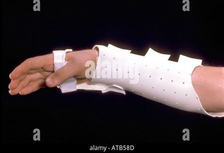 colles fracture splint position colles fracture splint position