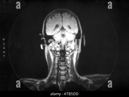 Normal anatomy NMR scan Stock Photo