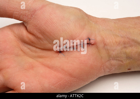 Surgery stitched carpal tunnel operation site one week after surgery Stock Photo