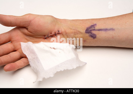 Surgery stitched carpal tunnel operation site one week after surgery Stock Photo