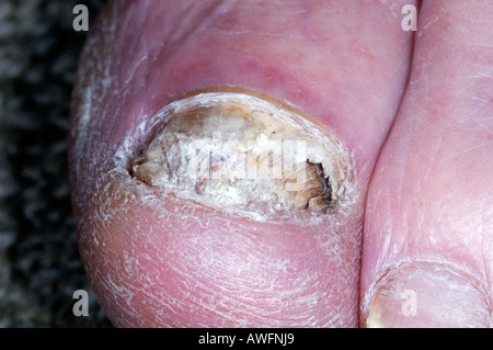 Great toe showing Fungal Infection . Onychomycosis Stock Photo