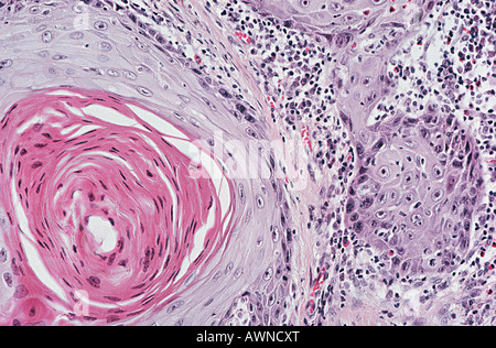 Squamous cell carcinoma Stock Photo