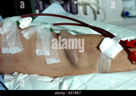 A female Patient on Haemodialysis Stock Photo