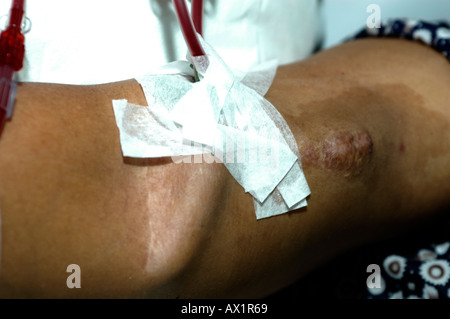 A female Patient on Haemodialysis Stock Photo