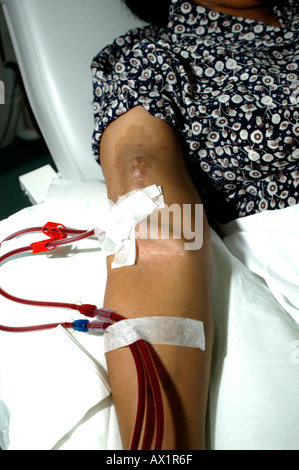 A female Patient on Haemodialysis Stock Photo