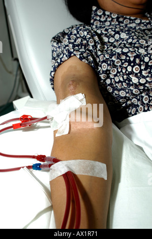 A female Patient on Haemodialysis Stock Photo