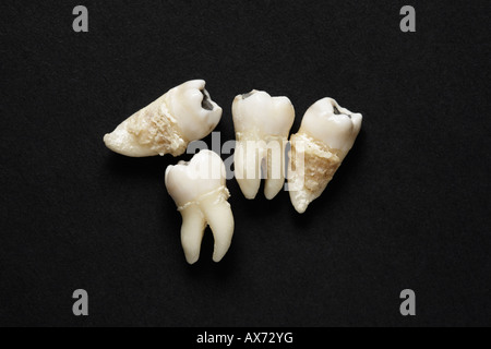 Extracted teeth on dark background Stock Photo