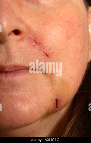 Scars on a womans face one week after cosmetic surgery. Stock Photo