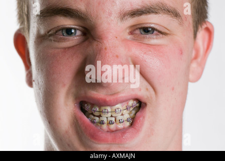 Teenage boy with acne and braces Stock Photo