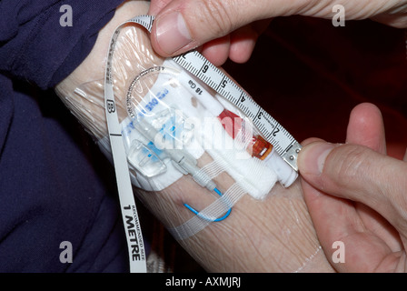 Measuring a Picc line after cleaning - peripherally inserted central ...