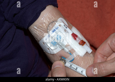 Measuring a Picc line after cleaning - peripherally inserted central catheter Stock Photo