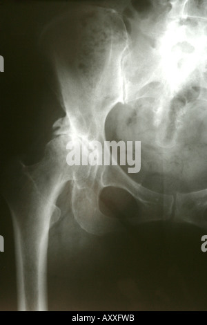 Film x-ray of human pelvis and hip joints Stock Photo - Alamy