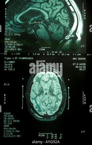 PARKINSON'S DISEASE, MRI Stock Photo - Alamy