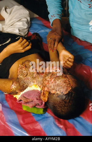 Bangladesh, Dhaka, acid attack survivor in Dhaka hospital Stock Photo