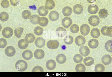 red blood cells infected with the malaria parasite Plasmodium vivax Stock Photo