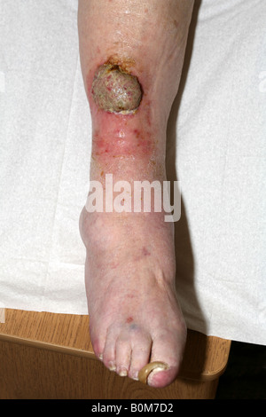 A 5cm malignant Squamous Cell carcinoma (skin cancer) on the lower leg of an elderly woman Stock Photo