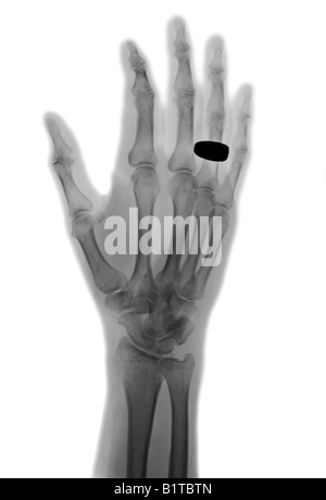 hand x-ray of a 68 year old man who fractured the tip of his thumb ...