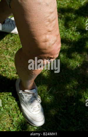 Stock photo of a seventy year old womans legs The image shows the varicose veins on the legs Stock Photo