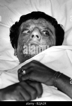 events, Iran-Iraq War 1980 - 1988, by poisen gas wounded man in a hospital, Irak, circa 1985, victims, chemical warfare, medical service, Iran, 20th century, historic, historical, people, 1980s, Stock Photo