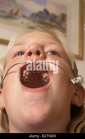 girl wearing braces with headgear Stock Photo