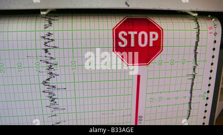 CTG, cardiotocograph Stock Photo