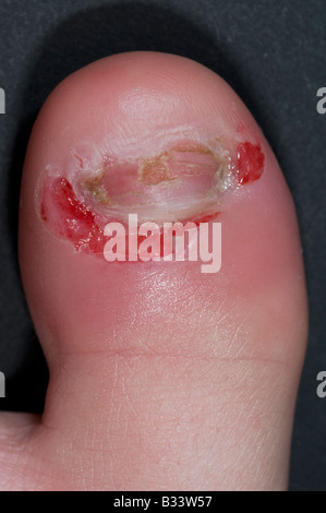 paronychia on the great toe of a 9 year old boy after incision and drainage Stock Photo