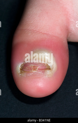 paronychia on the great toe of a 9 year old boy Stock Photo - Alamy