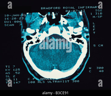 Close-up x-ray of a human head from above. Stock Photo