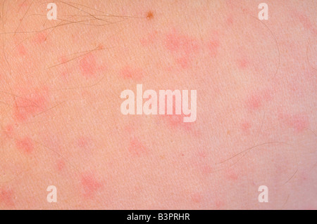 Allergic skin reaction caused by an intolerance to Penicillin Stock Photo