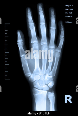 Hand Annotation X Ray Hand, fingers and thumb hospital x-ray scan test results for joint pain ...
