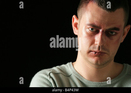 Man with shiner bruise black eye hematoma. Domestic violence male ...